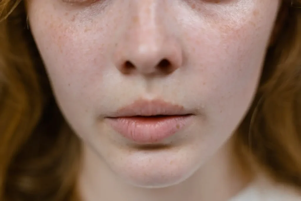 Close-up of a woman with acne-prone skin and facial redness, illustrating the gut-skin connection between digestion, inflammation, and acne breakouts naturally.