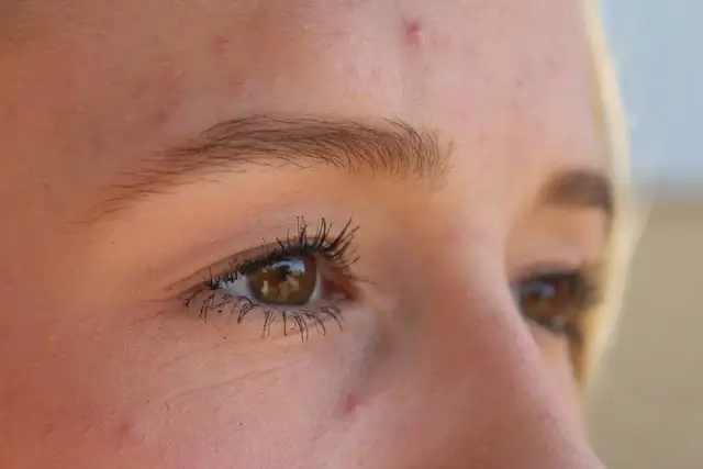 Close-up of acne-prone facial skin with several visible blemishes and redness around the forehead, cheek, and eye area, illustrating skincare concerns and gentle care for acne-prone skin.